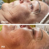 DermaSEMITA+ pokročilá LED svetelná terapia pre zdravú a žiarivú pleť