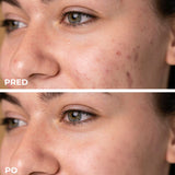 IPL Akné – Efektívne riešenie pre problematickú pleť