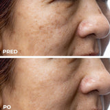 IPL Fotoomladenie – Riešenie pre nejednotný tón, pigmentácie, začervenanie a vrásky