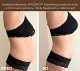 LIPOZERO™ Body Skalpel - Redukcia tuku a formovanie postavy