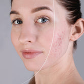 IPL Akné – Efektívne riešenie pre problematickú pleť