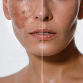 IPL Pigmentové škvrny – Efektívne riešenie pre rovnomernú a žiarivú pleť