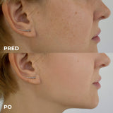 IPL Pigmentové škvrny – Efektívne riešenie pre rovnomernú a žiarivú pleť