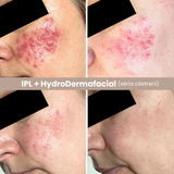 IPL Akné – Efektívne riešenie pre problematickú pleť