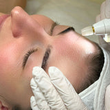 Plazmová blefaroplastika – lifting očných viečok a vyhladenie vrások bez skalpela a narkózy