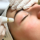 Plazmová blefaroplastika – lifting očných viečok a vyhladenie vrások bez skalpela a narkózy