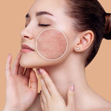 IPL Začervenaná pleť a cievne lézie – Účinná pomoc pre citlivú pokožku